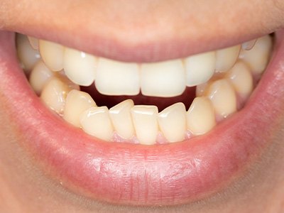 A closeup of a mouth with crowded teeth
