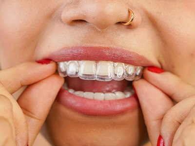 A young woman placing clear trays over her teeth