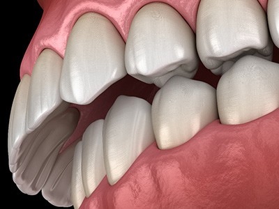 A 3D illustration of an overbite