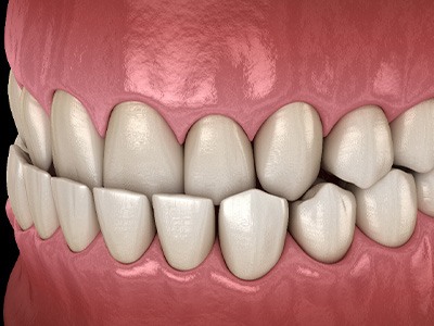 A 3D illustration of an underbite