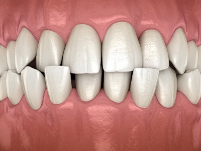 A 3D illustration of a crossbite