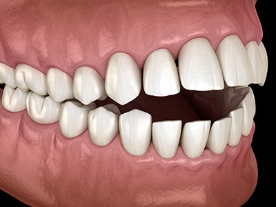 A 3D illustration of a mouth with an open bite