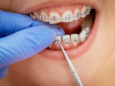 A closeup of a dentist adjusting a patient’s braces