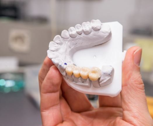 Model smile with a fixed bridge dental restoration