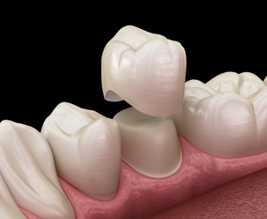 Animated smile during dental crown restorative dentistry treatment