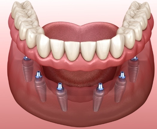 Animated smile during dental implant supported denture placement