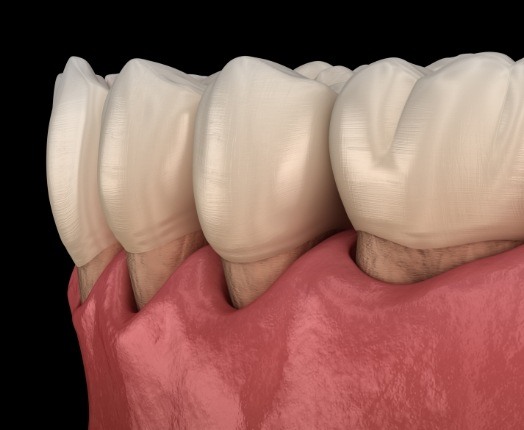 Animated smile in need of treatment for periodontal disease treatment