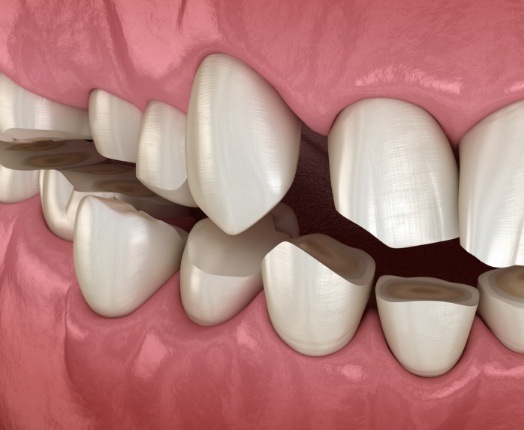 Animated smile with damage from teeth grinding before bruxism therapy