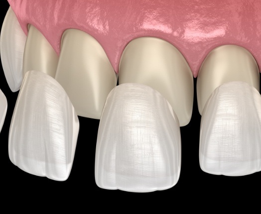 Animated smile during veneers cosmetic dentistry treatment