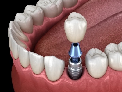 Animated dental implant supported dental crown placement