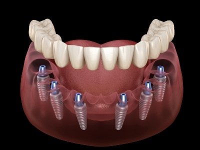 Animated dental implant supported denture placement