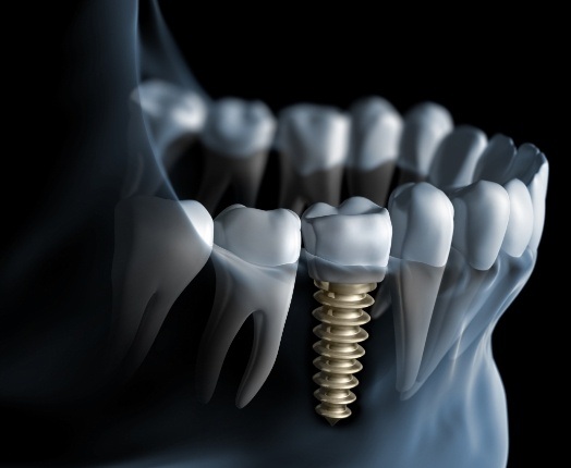 Animated smile with dental implant supported dental crown