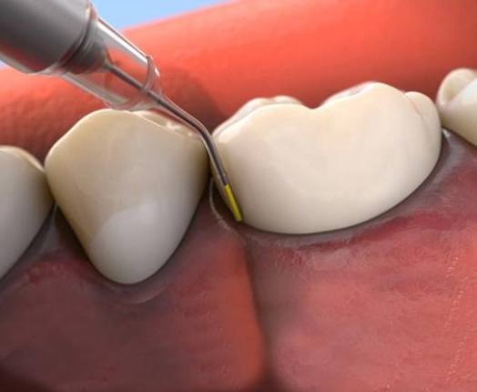 Animated smile receiving Arestin antibiotic treatment