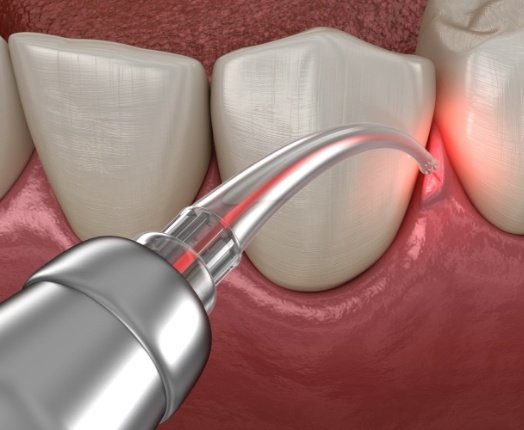 Animated smile receiving laser periodontal disease treatment