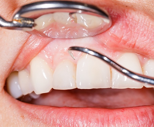 Closeup of smile during gum disease treatment