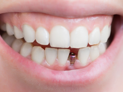 A closeup of a patient’s dental implant abutment
