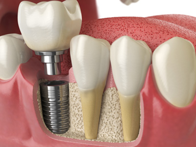 : A 3D illustration of a complete dental implant