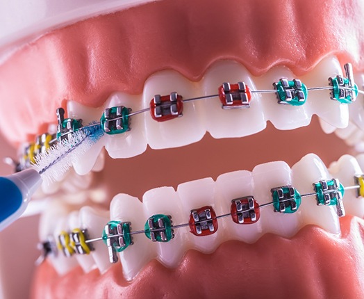 a model of a mouth with braces