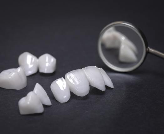 Different dental restoration including Lumineers