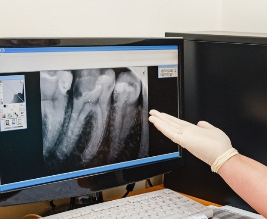 Dentist motioning to digital x-rays on chairside computer
