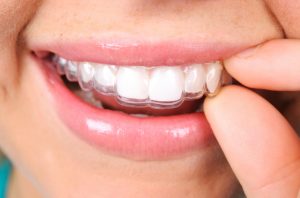 Why should I get Invisalign in Copperas Cove?