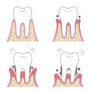 Gum disease can wreak havoc on your oral health, but your dentist in Copperas Cove explains the symptoms you should be aware of.