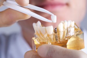 Dental implants from your dentist in Copperas Cove can bring back the radiant smile you once had. 