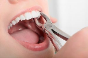 emergency tooth extraction