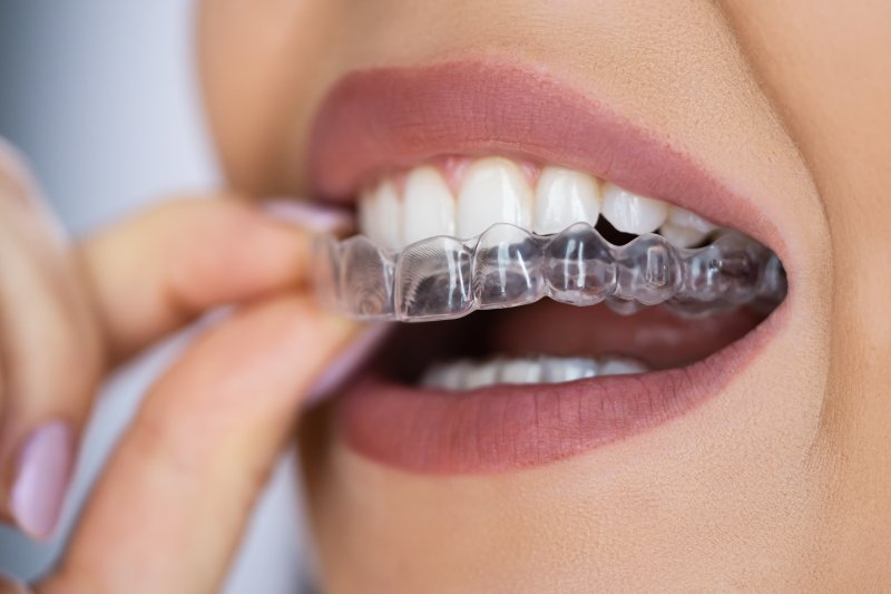 A woman placing mail-in clear aligners over her teeth